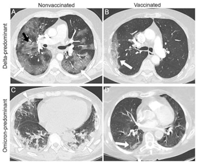 Representative examples of patients with different vaccine statuses during the delta-predominant and omicron-predominant periods. (A) Axial CT pulmonary angiogram (CTPA, with lung kernel) of a 65-year-old, nonvaccinated, male patient during the delta-predominant period showing typical CT for COVID-19, i.e., bilateral and asymmetric ground glass opacities (GGOs, white arrows) affecting the central and peripheral lung, associated with reticulations (black arrow) responsible for the 'crazy paving' aspect. The severity score assessed on the entire CTPA was 'severe' extent. (B) Axial CTPA in 57 years old vaccinated male patient (2 doses) during the delta-predominant period showing a 'compatible' chest CT for COVID-19, i.e., single unilateral peripheral GGO (white arrow), with a 'minimal' severity score. (C) Axial chest CT without contrast medium injection in a 69-year-old nonvaccinated male patient during the omicron predominant showing peripheral, bilateral, and asymmetric consolidations (white arrowhead), classified as 'compatible' with COVID-19. The severity score on the entire chest CT was 'extended.' (D) Axial CTPA in a 70-year-old vaccinated female patient (3 doses) showing a single small peripheral lesion combining GGO and consolidation (white arrow) classified as 'indeterminate' with a 'minimal' severity score. Images and caption courtesy of Radiology.
