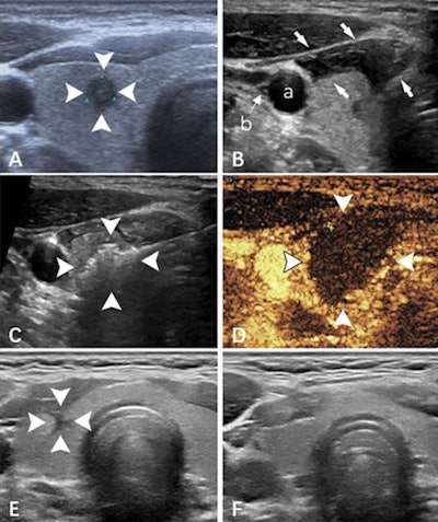 Ultrasound images show papillary thyroid carcinoma in the right lobe of the thyroid in a 36-year-old man. (A) Imaging shows the tumor pre-ablation (arrowheads). (B) The hydrodissection technique (arrows) was used to protect the carotid artery (a) and vagus nerve (b). (C) Imaging shows a hyperechoic pattern in the tumor during the ablation procedure (arrowheads). (D) Postablation contrast-enhanced imaging shows no enhancement in the tumor area (arrowheads). (E) Imaging shows the ablation zone six months after ablation (arrowheads). (F) The ablation area has almost disappeared one year after ablation. Images and caption courtesy of Radiology.