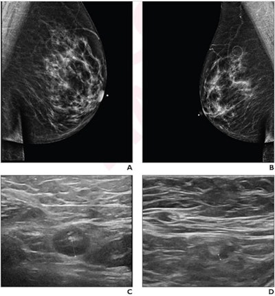 A 64-year-old woman who underwent screening mammography and breast ultrasound presented with left axillary lymphadenopathy. (A) Right and (B) left images show mediolateral oblique views that were obtained two days after a booster dose of the Pfizer COVID-19 vaccine administered in the left upper extremity shows. No right axillary lymphadenopathy was visualized. (C) Left axillary ultrasound performed on the same day as the mammogram shows an enlarged left axillary lymph node (calipers) with thickened cortex, measuring 6 mm. (D) Left axillary ultrasound performed 102 days after the booster dose shows normal lymph node (calipers) with a cortical thickness of two mm, consistent with resolution of lymphadenopathy. Images and caption courtesy of the American Roentgen Ray Society.