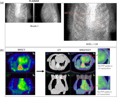 (A) Three-hour planar imaging interpreted as 'equivocal for ATTR amyloidosis.' Visual assessment of planar images further demonstrates relatively less myocardial uptake compared with the ribs. (B) SPECT alone demonstrates an empty-looking left ventricular (LV) cavity, which is shown to be the thickened septal wall on the fused CT images. Also note that the inferior lateral border of the LV wall is not demonstrating any radiotracer uptake with SPECT/CT fusion. SPECT/CT reclassifies the case from equivocal to 'not suggestive.' Image and caption courtesy of the Journal of Nuclear Cardiology through CC BY 4.0.