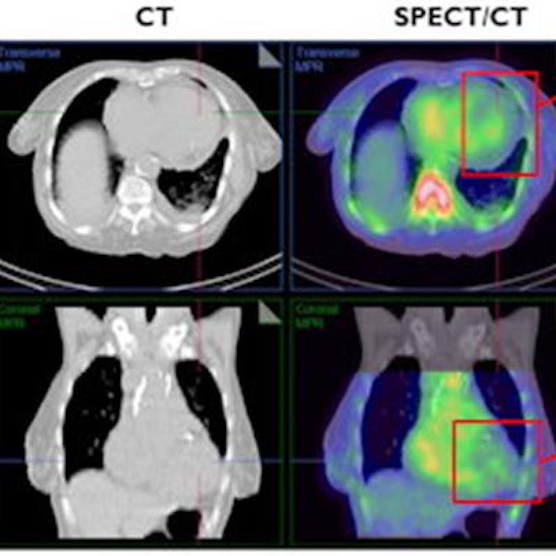 SPECT/CT superior to SPECT alone for imaging cardiac amyloidosis ...