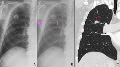 Example of a lung lesion detected by the AI Rad Companion Chest X-ray (A, B) that was confirmed by a CT scan of the chest (C): A 74-year-old, male patient diagnosed with a carcinoma of the tongue two years ago. Image and caption courtesy of Scientific Reports through CC BY 4.0.