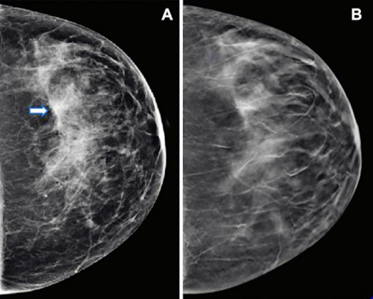 How Has Mammogram Technology Improved?