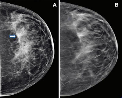 Images show mammography results in a 47-year-old woman who presented for routine screening. (A) Craniocaudal digital mammogram shows scattered fibroglandular densities. On the left digital mammographic craniocaudal view laterally, an asymmetry (arrow) is present. (B) Left craniocaudal DBT imaging shows no suspicious lesion, but rather a superimposition of normal fibroglandular and ligamentous structures. Images and caption courtesy of the RSNA.