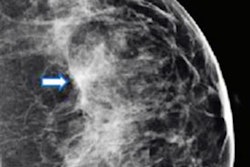 2023 03 13 22 13 1666 2023 03 14 Radiology Dbt Mammo 20230313224101