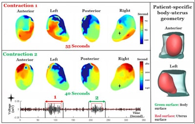 In this example, two adjacent contractions were imaged during labor. Electromyometrial imaging shows that the first contraction starts from the middle segment of the uterus and propagates up and down simultaneously. The entire electrical activation underlying the contraction takes around 55 seconds. The second contraction starts from the fundus region (top of uterus) and propagates down in a faster (40 seconds) and synchronized manner than the first contraction. Image and caption courtesy of Washington University in St. Louis, MO.