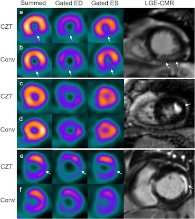 Patient examples of myocardial infarct (MI) by cardiac MRI, myocardial perfusion SPECT with a cadmium-zinc-telluride (CZT) gamma camera and a conventional (Conv) gamma camera. Columns from left to right show summed myocardial perfusion SPECT images, gated myocardial perfusion SPECT in end-diastole (ED) and end-systole (ES) and late gadolinium enhancement (LGE) cardiac MRI. Case a and b are examples of an infarct in the apical inferior wall on cardiac MRI, which is correctly diagnosed by both CZT and conventional SPECT (arrows). Case c and d are examples of an infarct in the apical lateral wall on cardiac MRI (arrow), missed by both CZT and conventional SPECT. Case e and f are examples of an infarct in the basal lateral wall on cardiac MRI correctly diagnosed by the CZT camera (arrows) but missed by conventional SPECT. Image courtesy of the Journal of Nuclear Medicine through CC BY 4.0.
