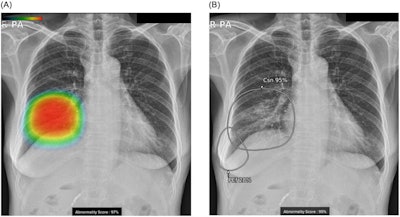 Chest radiographs of a 57-year-old female with pneumonia and right pleural effusion. Images are results analyzed with (A) version 2 and (B) version 3 of the AI-based lesion detection software. (A) Version 2 can detect and display three types of lesions (consolidation, nodule, and pneumothorax) with a color heatmap and total abnormality score. (B) Version 3 can detect and display nine types of lesions (six additional types of the lesion in addition to the three lesions detected in version 2) with a grayscale heatmap and abnormality score for each lesion. Note the right pleural effusion that was additionally detected and displayed with version 3 of the software. Image courtesy of PLOS One through CC BY 4.0.