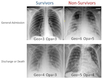 Examples of chest x-rays with different geographic extent and opacity scores. Chest x-rays of COVID-19-positive patients were scored (range, 0-8) based on the extent and degree of opacities. Image and caption courtesy of Diagnostics through CC BY 4.0.