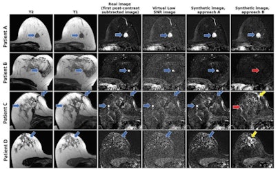 From left to right: axial T2-weighted images, axial T1-weighted images before contrast agent administration, real subtraction images (first postcontrast subtracted images), virtual lowâ€“signal-to-noise ratio (SNR) images, synthetic images generated with approach A, and synthetic images generated with approach B. Images in a 62-year-old woman (patient A) with invasive breast cancer that was stage pT1c, NST grade III, and triple-negative. Contrast enhancement (blue arrows) was accurately reconstructed by both approaches. Images in a 57-year-old woman (patient B) with invasive breast cancer that was stage pT1c, NST grade II, and luminal B. Approach B missed the contrast-enhancing lesion (red arrow). Images in a 64-year-old woman (patient C) who presented for follow-up after resection of invasive breast cancer 1 year prior. Contrast enhancement is both missed (red arrow, fibroadenoma) and falsely synthesized due to scar tissue (yellow arrow) by approach B. Images in a 44-year-old woman (patient D) who presented for screening. No contrast-enhancing lesions were seen. However, approach B synthesized contrast enhancement (yellow arrow). Images and caption courtesy of the RSNA.