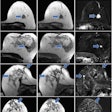 2023 03 22 23 57 2291 2023 03 21 Radiology Breast Contrast Mri 20230322234906