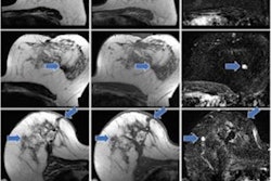 2023 03 22 23 57 2291 2023 03 21 Radiology Breast Contrast Mri 20230322234906