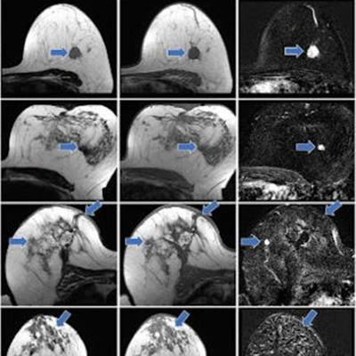 Can machine learning reduce breast MRI contrast dose? | AuntMinnie