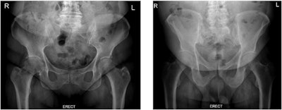 Erect pelvic x-rays with the use of tissue displacement technique (left image) and without the use of tissue displacement technique (right image). Image courtesy of Radiography under CC BY 4.0.