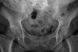 2023 03 24 03 46 1699 2023 03 24 Pelvis X Ray 20230324033118