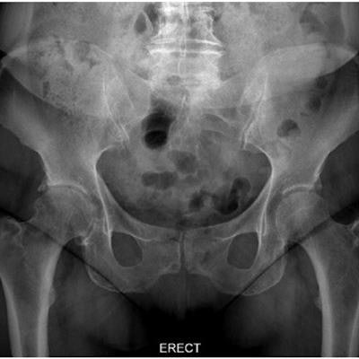 Pelvis x-ray Information