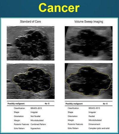Dr. Thomas Marini from the University of Rochester Medical Center presented findings suggesting that combined volume sweep imaging and artificial intelligence could accurately diagnose palpable breast lumps. Here, the combined method (right) is compared to standard of care (left), with both agreeing that the imaged area is possibly malignant. Image courtesy of Dr. Thomas Marini.