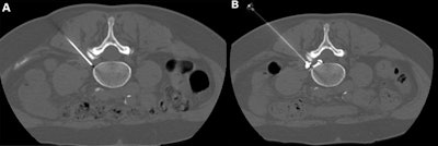CT-guided pulsed radiofrequency (PRF) with transforaminal epidural steroid injection. A 62-year-old woman underwent PRF followed by transforaminal epidural steroid injection for sciatica due to left contained intraforaminal disk herniation at the L4-5 level. (A) A 22-gauge needle electrode with a 10-mm active tip was introduced and advanced using one 3-mm oblique axial unenhanced CT scan, which revealed that the needle tip was proximate to the target dorsal root ganglion with the lateral foraminal portal of entry. (B) Sensitive stimulation (50 Hz) PRF current with a threshold of no more than 0.2 V was used to confirm proper positioning by evoking tingling or electric pain in the dermatome that had to match the target dorsal root ganglion. Therapeutic PRF was then performed in one 10-minute session with E-dose functionality, maintaining temperature below the threshold for neural damage (42°C) and a constant voltage (45 V) (G4 RF Generator; Boston Scientific). Immediately after PRF administration, epidural spread of 0.3 mL of contrast material (350 mg of iodine per milliliter, Iomeron; Bracco) was confirmed using intermittent intraprocedural CT fluoroscopic imaging with no intravascular contrast material flow demonstration. A combination of steroid and anesthetic (1 mL lidocaine [ 20 mg/mL] and 2 mL dexamethasone [10 mg/mL]) was then injected without altering needle position to conclude the procedure. Image and caption courtesy of Radiology.