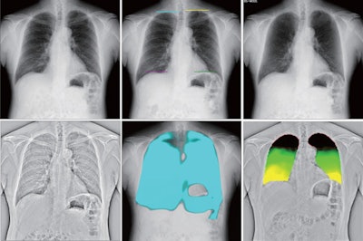 Several dynamic images obtained by DCR. Original DCR (A) is a simple dynamic image; diaphragm motion tracking processing mode (DM-mode) (B) emphasizes the movement of the diaphragm; bone suppression processing mode (BS-mode) (C) has the clavicle and ribs erased; and frequency enhancement processing mode (FE-mode) (D) enhances the visibility of the lung marking. Reference frame ratio calculation processing mode (PL-mode) (E) and lung motion tracking processing mode (LM-mode) (F) concern ventilation. PL-mode shows the dynamic ventilation image, demonstrating a blue shadow in the position where the lung tissue is expanded by breathing. LM mode visualizes upward movement of the lungs during expiration. The colorless area shows where there is little movement. Image and caption courtesy of the Journal of Thoracic Disease through CC BY 4.0.