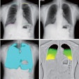 2023 03 28 20 26 2502 2023 03 29 Dcr Pleural Adhesions 20230328210408