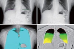 2023 03 28 20 26 2502 2023 03 29 Dcr Pleural Adhesions 20230328210408