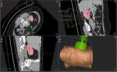 HistoSonics' hithotripsy platform provides image-guided sonic beam therapy for solid kidney tumors. Image courtesy of HistoSonics.