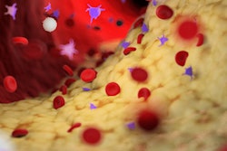 2021 06 29 18 14 2350 Plaque Artery 400