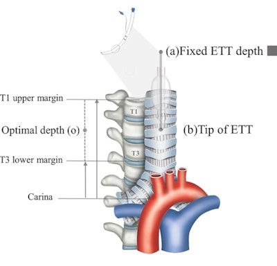 Process to estimate optimal depth of endotracheal tube using machine-learning model. (A) Acquire the recorded value of (a) fixed endotracheal tube depth from the electronic medical record and measure the distance from the carina to the tracheal tube tip (b) on the chest x-ray. Then, assume that the median of the distance from the carina to the upper margin of T1 and the distance from the carina to the lower margin of T3 is the optimal tracheal tube tip position (o). Finally, the ETT optimal depth value is derived by moving (a) as much as the distance that (b) has moved to the position of (o). Image courtesy of Scientific Reports through CC BY 4.0.
