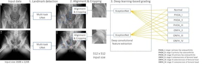 A schematic of the proposed deep learning (DL)-based framework for hip x-ray grading showing two examples, one for the anterior posterior view and the other for the frog-leg lateral view, with each image independently classified by trained convolutional neural networks. First (step 1), a multitask UNet was trained to detect landmarks for localizing hip joints. For this step, the x-ray was resized to 1024 x 1024 pixels. Then (step 2), the cropped image, after data augmentation, was resized to 256 x 256 pixels and used as the input for an ImageNet-pretrained XceptionNet, which served as a deep convolutional feature extractor. Finally (step 3), fully connected layers were trained to classify each x-ray into one of the seven diagnostic categories. Image and caption courtesy of Osteoarthritis Imaging through CC BY 4.0.