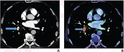 (A) Axial image shows nonocclusive filling defect (arrow) in right lower lobe basal trunk. AI classified examination positive for pulmonary embolism (PE). (B) Activation map shows location corresponding to PE (arrow) identified by AI. Examination reprioritized on radiologist reading worklist, given positive result from AI tool. Wait time: 6.7 minutes; read time: 17.2 minutes; turnaround time: 23.9 minutes. Image and caption courtesy of the AJR.