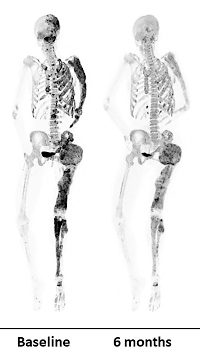 PET bone scans of a patient before (left) and after (right) a six-month denosumab treatment show reduced turnover within fibrous dysplasia lesions (dark-colored patches). Image courtesy of Dr. Alison Boyce, NIDCR.
