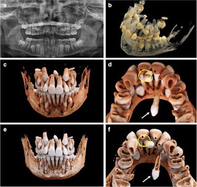 An 11-year-old boy with a mesiodens and a supplementary tooth (white arrows) within the hard palate. (a) An x-ray of the boy's mouth. (b) A display of the semitransparent reconstruction parameters. (c and d) The bone reconstruction parameters with a soft kernel can lead to artifacts in regions with teeth near each other (yellow circle in d, e, and f.) The same situation is shown with a hard kernel, allowing better differentiation between the roots of the mesiodens and of tooth #21 (yellow circle in f).