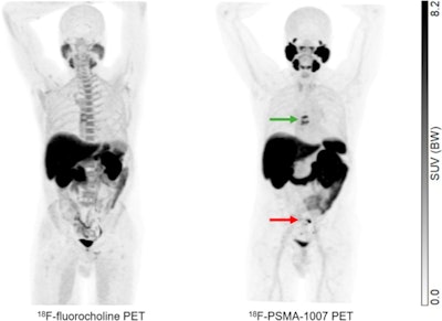 A 62-year-old patient with a history of prostate cancer initially treated with prostatectomy, prostate bed radiation therapy, and six months of androgen deprivation therapy (ADT), who presented with suspected recurrence (prostate-specific antigen [PSA] level of 5.7 ng/mL). F-18 PSMA-1007 PET/CT detected pelvic lymph nodes (red arrow) and bone metastases (green arrow) that were not detected by F-18 fluorocholine PET/CT. Therapeutic management changed from targeted radiation therapy before PET to ADT after PET, leading to drop in PSA level to 0.1 ng/mL at six months. Image and caption courtesy of the Journal of Nuclear Medicine through CC BY 4.0.