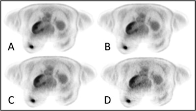 PET images of a 54-year-old breast cancer patient with a good subjective image quality score (5-point scale: 4) for all reconstruction times of 20 minutes (A), 15 minutes (B), 10 minutes (C), and five minutes (D). Image and caption courtesy of European Radiology through CC BY 4.0.
