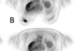 2023 04 14 15 53 4008 2023 04 14 Pet Mri Breast 20230414155039