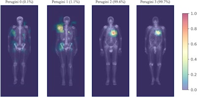Highlighted areas contribute the most to the positive prediction in the convolution layers. For Perugini 2, 3, and false positive images, the heart area is clearly highlighted. The predicted probability of each image to be positive is indicated at the top of the image. On the right is the probability scale. Image and caption courtesy of JACC: Cardiovascular Imaging through CC BY 4.0.