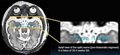 Measurements complete by medical student under supervision of two pediatric neuroradiologists with more than eight years of reading experience. Image and caption courtesy of the ARRS.