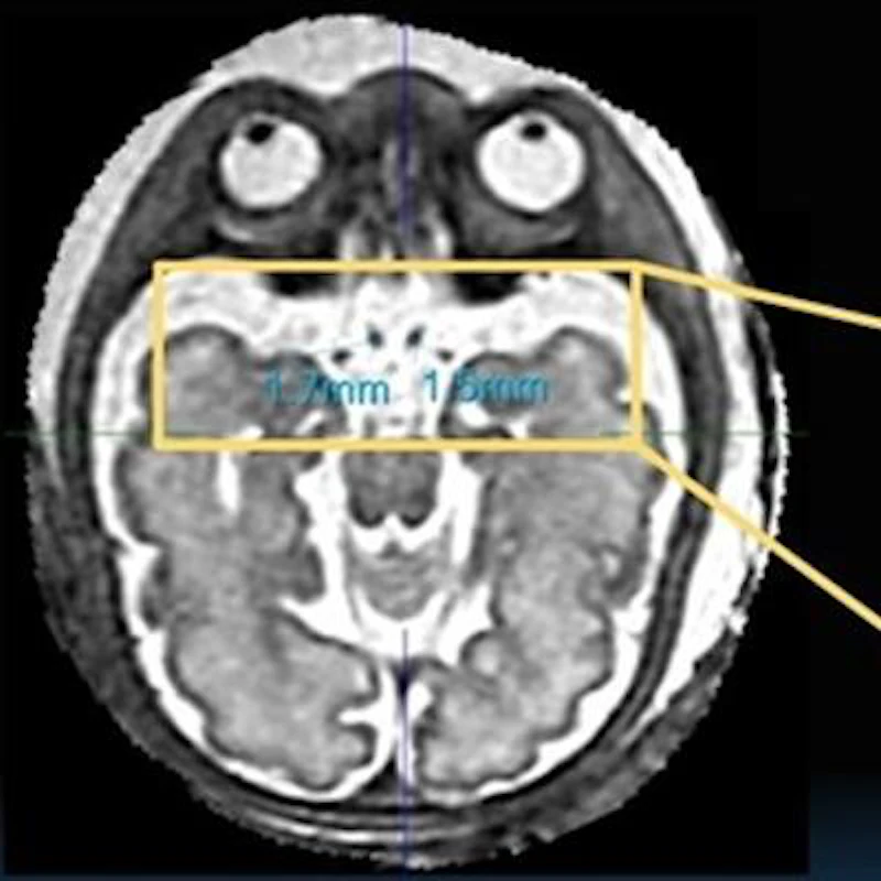 Volume Mri 3D slice-to-volume MRI can 'see' fetal optic pathway | AuntMinnie