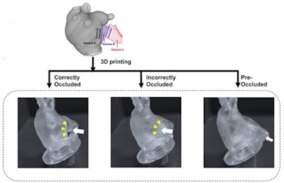 Life-sized left atrial phantoms of an 86-year-old patient with persistent atrial fibrillation were 3D printed from cardiac CT images. Setting a custom-made, closed-loop flow circuit, a pump delivered pulsatile pulmonary venous flow. Using a 3-tesla scanner (Philips Achieva TX), 4D flow MRI was obtained, then analyzed via MATLAB-based software. Flow metrics associated with blood stasis and thrombogenicity -- stasis volume defined by velocity threshold (|V| < 3 cm/s), time-averaged wall shear stress (WSS), and endothelial cell activation potential (ECAP) --were compared among three conditions. Image and caption courtesy of the ARRS.