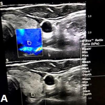 2023 04 18 17 24 2443 2023 04 18 Arrs Elastography Thyroid 20230418175206