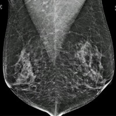 Bilateral mammogram shows mixed density glandular breast tissue with no