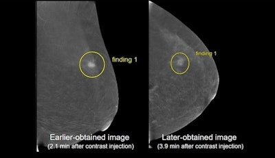 An online scientific poster presentation led by Dr. Dennis Dwan from the Beth Israel Deaconess Medical Center found that projection order and acquisition time matter when it comes to contrast-enhanced mammography. These CEM images show an earlier-obtained image described as mass and a later-obtained image described as non-mass enhancement by the same reader for images of the same patient. Images courtesy of the ARRS.