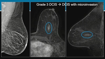 Researchers at the ARRS annual meeting described false-negative rates and characteristics on screening digital breast tomosynthesis (DBT). For these images, Dr. Manisha Bahl from Harvard Medical School described an asymptomatic false-negative case from a 53-year-old woman with a personal history of breast cancer. About 10 days after her initial screening, the woman underwent high-risk breast MRI which showed linear nonmass enhancement in the central area of the left breast. MRI-guided biopsy indicated grade-three ductal carcinoma in situ (DCIS), though this was upgraded to DCIS with microinvasion upon mastectomy. Images courtesy of ARRS.