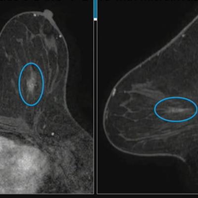 Research sheds light on how breast cancer might develop after