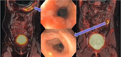 An image presented by Dr. Anthony Jiang of the University of Wisconsin during a talk on the added value of FDG-PET in Crohn's disease imaging. The image shows radiotracer uptake in a patient in areas of active inflammation. Image courtesy of Dr. Jiang.
