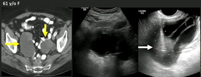 Researchers at the ARRS annual meeting presented the results of a 20-year study showing the efficacy of biopsying pelvic lesions with transvaginal ultrasound (TVUS). Here, images show bilateral cystic masses in a 61-year-old woman with a history of metastatic colon cancer. The middle image is a transabdominal ultrasound image that shows the cystic aspect, but not the solid parts. The right image is a TVUS image showing a solid nodule. Diagnostic concordant biopsy showed this was a metastatic colonic adenocarcinoma. Images courtesy of ARRS.