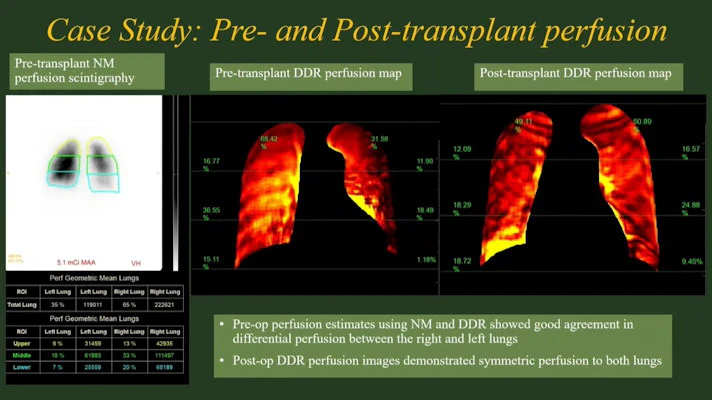 Am Radiographic Dynamic digital radiography tested in lung transplant patients | AuntMinnie