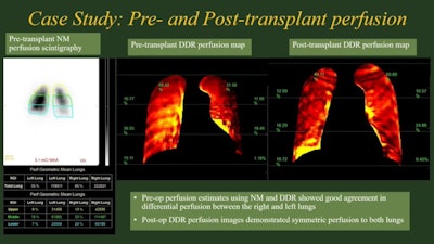 Dr. Padma Manapragada of the University of Alabama Birmingham presented a study of the use of dynamic digital radiography in preoperative lung transplant patients at ARRS 2023 in Honolulu. Image courtesy of Dr. Manapragada.
