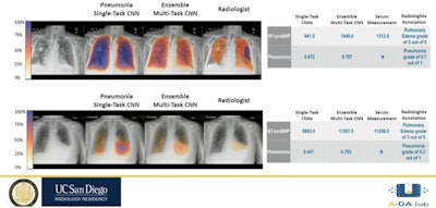 Dr. Melina Hosseiny of the University of California, San Diego, described an AI algorithm at ARRS 2023 designed as an aid for differentiating and diagnosing pneumonia and pulmonary edema. Image courtesy of Dr. Hosseiny.