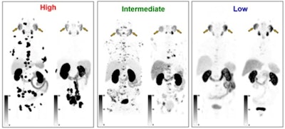Representative images of six patients classified as having high, intermediate, and low vPSG scores. Image courtesy of the Journal of Nuclear Medicine.